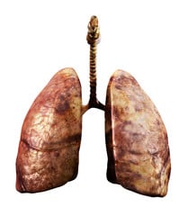 Pneumonoultramicroscopicsilicovolcanoconiosis Silicosis Black Lung Disease